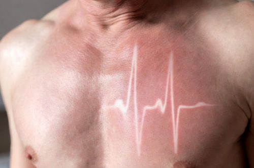 Тахикардия