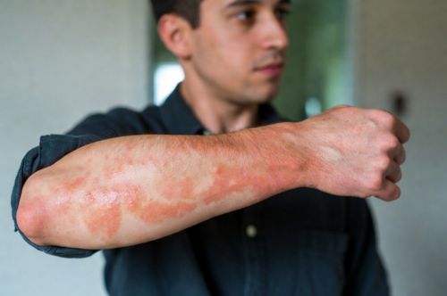 Аллергический дерматит