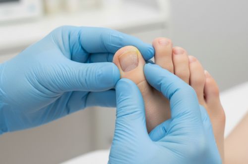 Онихомикоз (грибок ногтей)