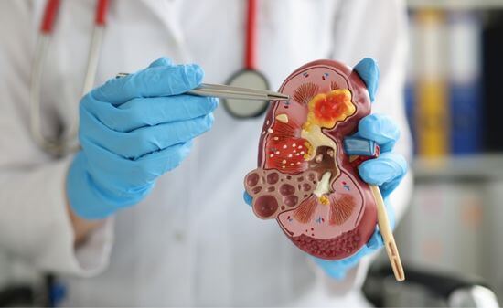 Степени варикоцеле