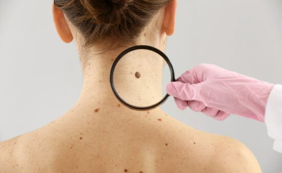 Родинки: почему они появляются и что с ними делать? 