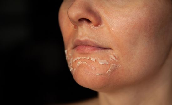 Шелушение кожи