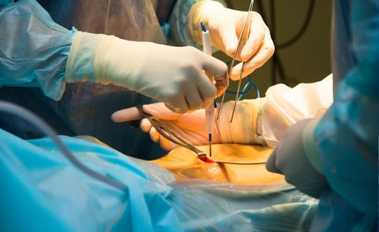 Лапароскопия