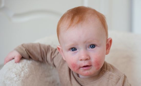 Атопический дерматит