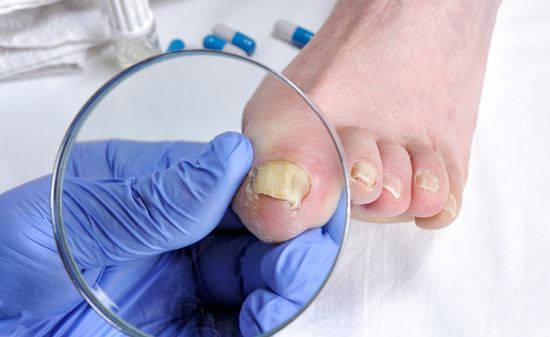 Онихомикоз (грибок ногтей)